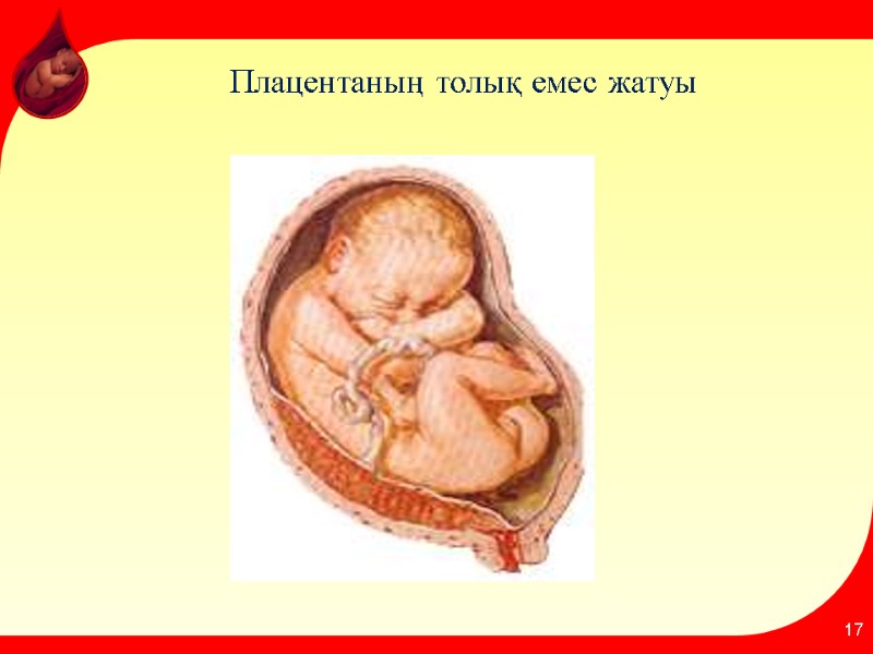 Плацентаның толық емес жатуы 17